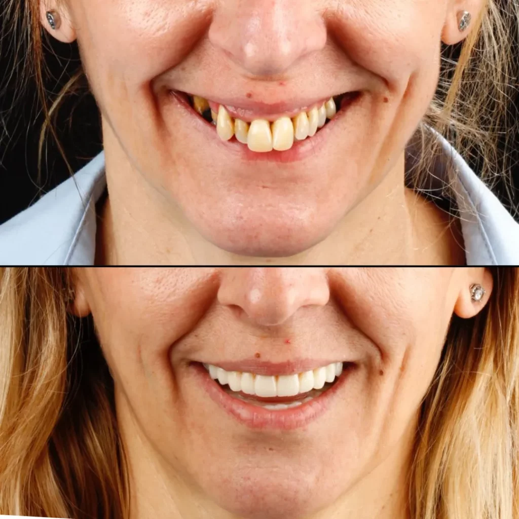 libreria de dientes stl para exocad