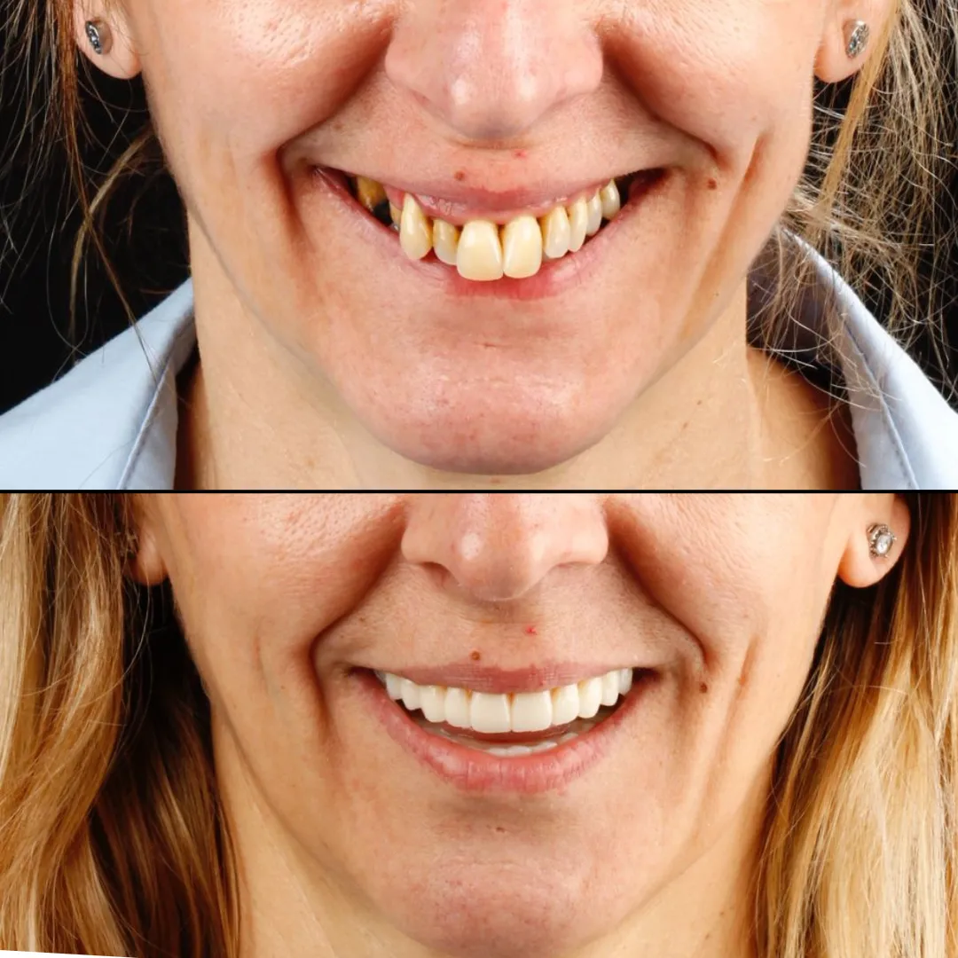 libreria de dientes stl para exocad