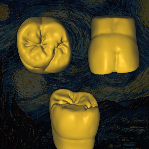 Restauración CAD/CAM en anatomía dental envejecida - Old Van Gogh.