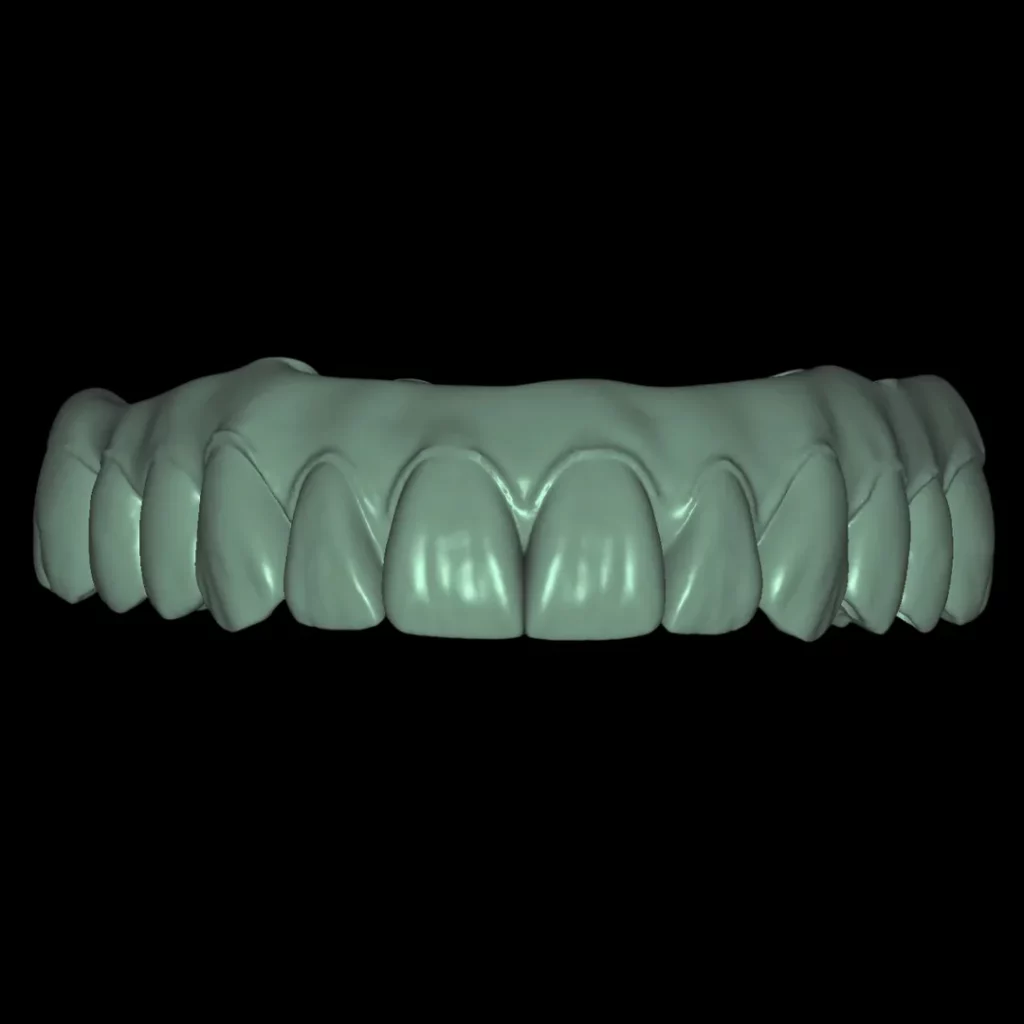 Rehabilitación superior completa con encía diseñada por CAD en el centro de diseño dental Prodecad