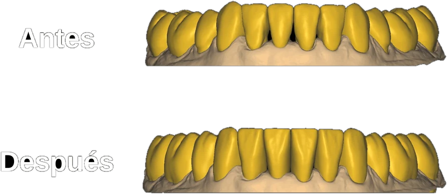 Antes y despues de una anatomia dental disenada en exocad